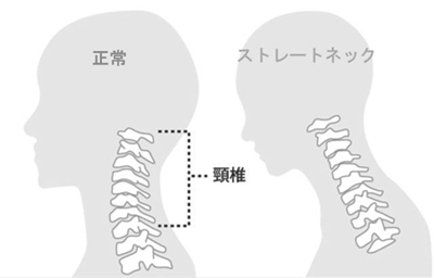 ストレートネック①